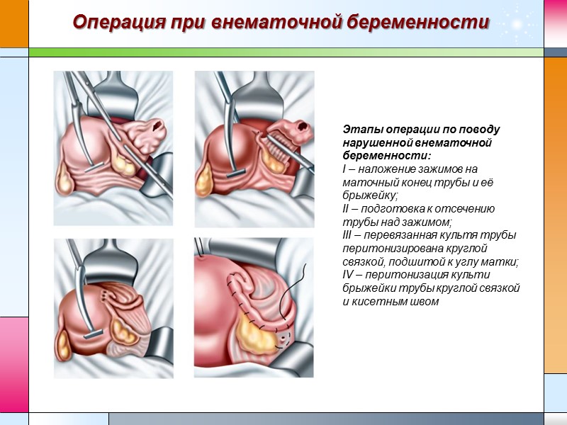 Операция при внематочной беременности  Этапы операции по поводу нарушенной внематочной беременности: I –